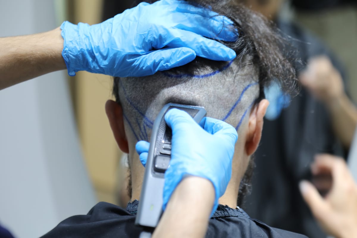 A man prepares to receive a hair transplant in Elithair, Istanbul (Dispatch)